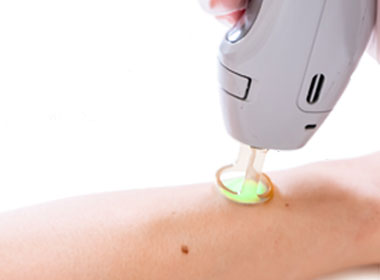 laser hair removal 2
