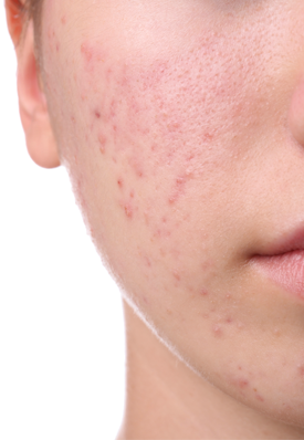 acne 2